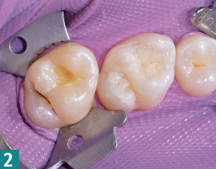 Реставрация DMG Constic - этап 2